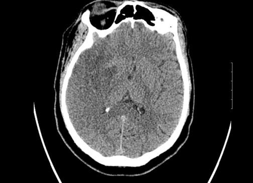 Abnormality noted in the Right Middle Cerebral Artery