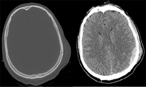 Extra-axial hemorrhage associated with an acute fracture