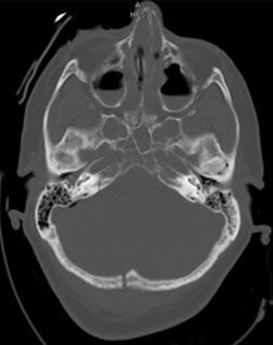 Occipital fracture with extension into the petrous portion of the temporal bone