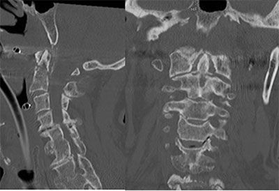 Type 2 Odontoid Fracture