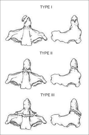 The three types of Odontoid fractures