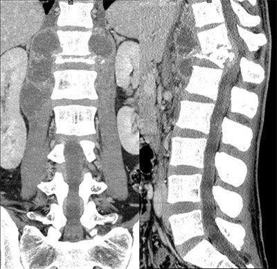 CT scan of a spine