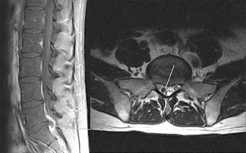 CT scan of a sequestered disc